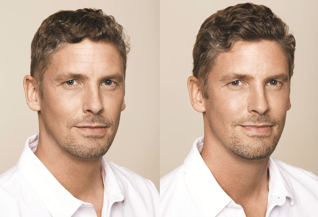 Before and After Cosmetic Injections
